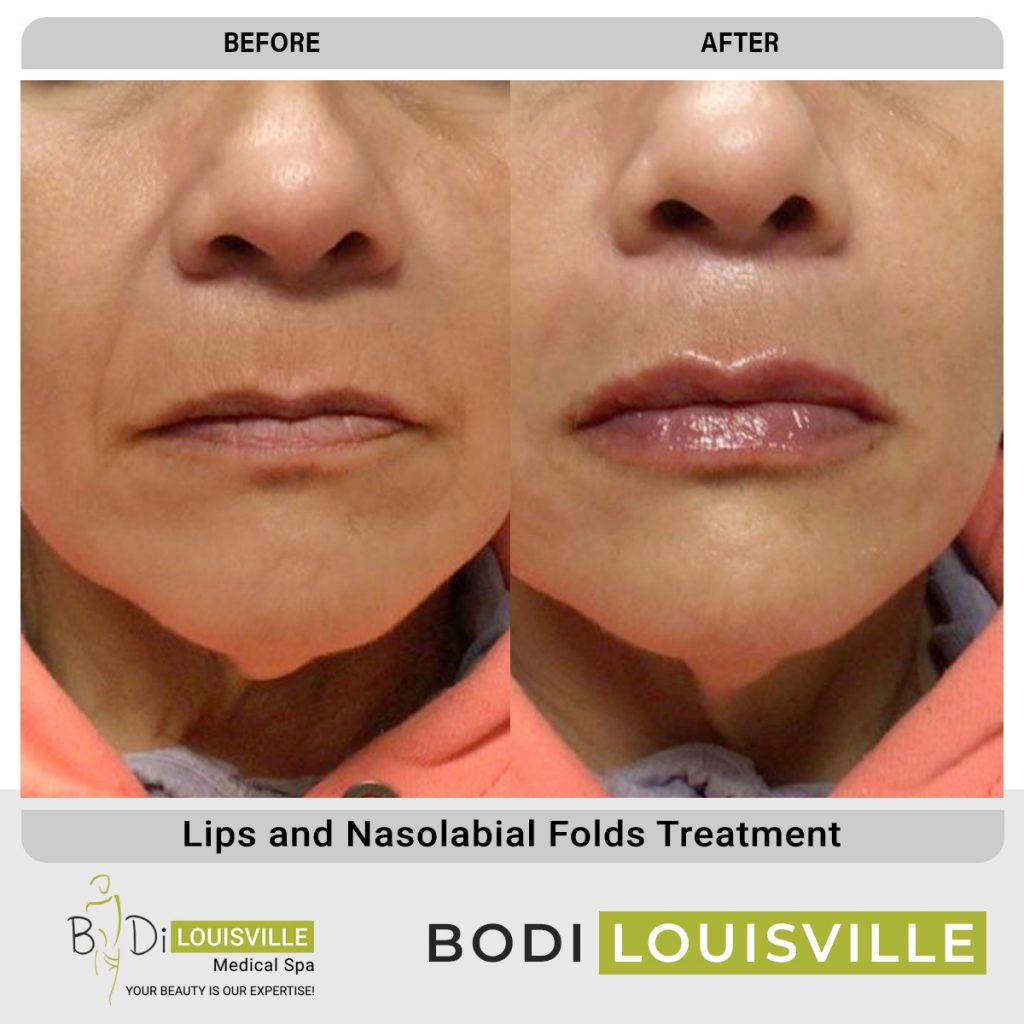 Lips Treatment Louisville